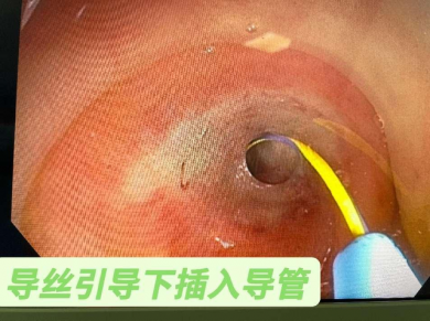 平舆县人民医院成功开展内镜下逆行性阑尾炎治疗术